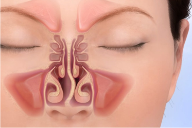 Sinus Surgery in Gurgaon India, Best ENT Centre for Sinusitis Treatment in India, Functional Endoscopic Sinus Surgery (FESS) in Gurgaon India